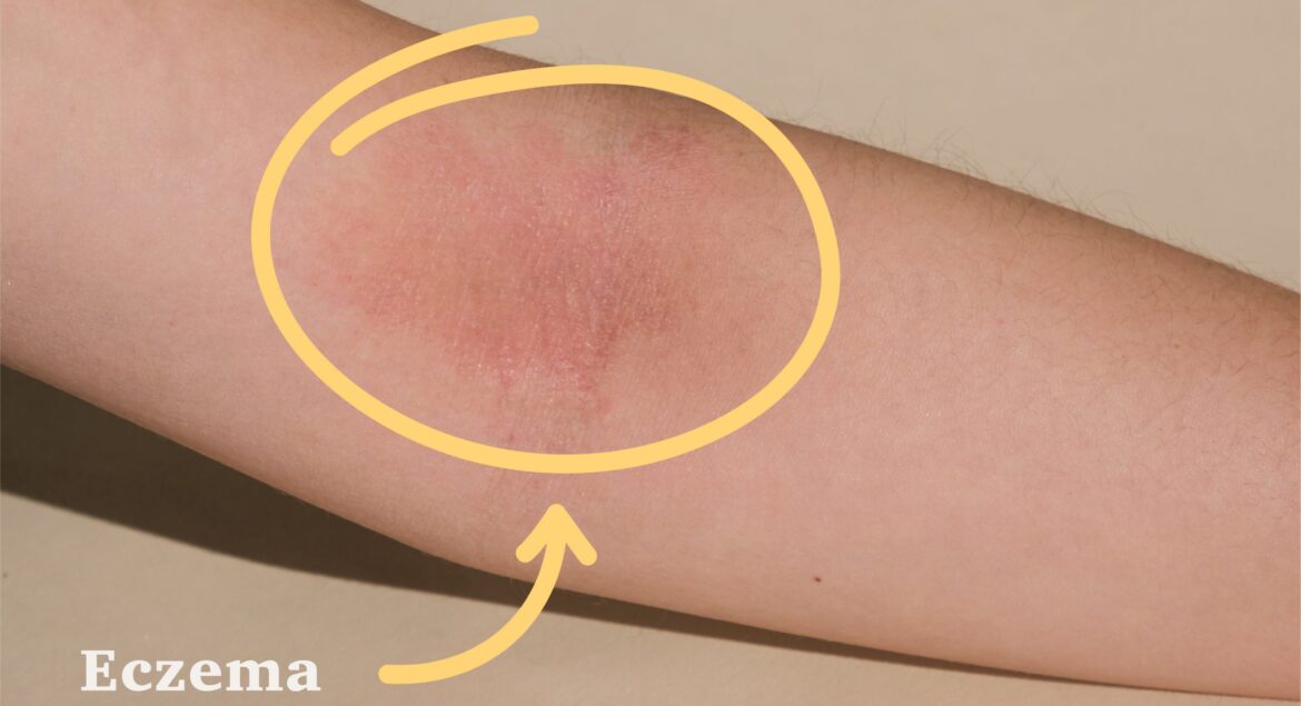 RR-Blog-Eczema-01-scaled.jpg